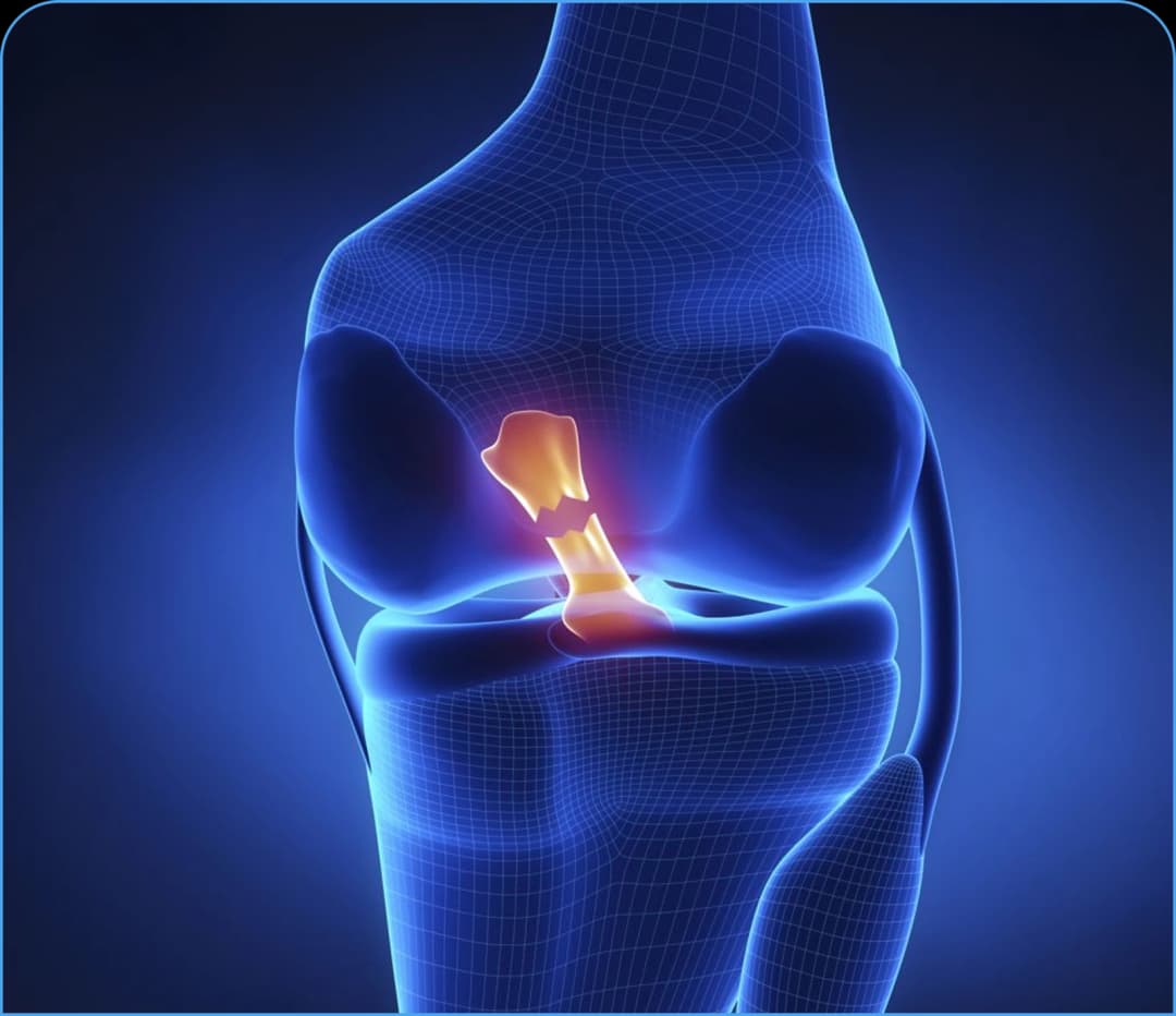 ACL TEAR: SYMPTOMS, CAUSES